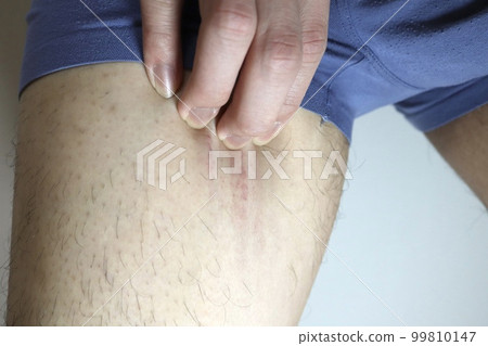 男子大腿抓撓過多內出血 男子大腿抓撓過多內出血 99810147