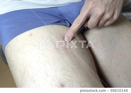 男子大腿抓撓過多內出血 99810148