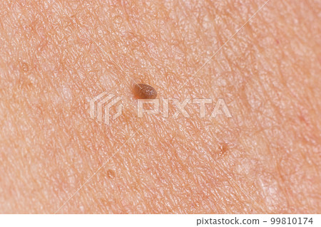 Papilloma on human skin - benign tumor in the form of mole, nevus Papillomatosis medicine Papilloma on human skin - benign tumor in the form of mole, nevus Papillomatosis medicine 99810174