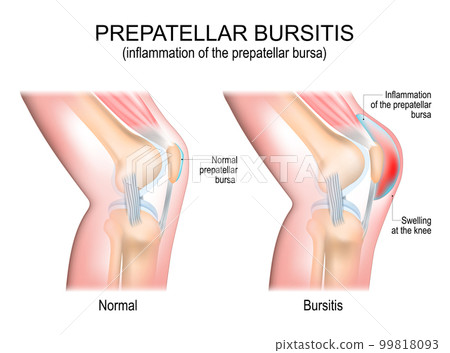 Prepatellar bursitis. inflammation of the prepatellar bursa 99818093