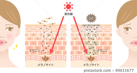 Mechanism of blemishes and UV rays A cross-sectional view of a woman's skin before and after Mechanism of blemishes and UV rays A cross-sectional view of a woman's skin before and after 99831677