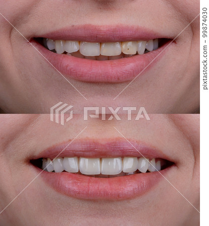 Before and after of smile makeover by dental ceramic veneer, porcelain laminate veneers on front teeth. Before and after of smile makeover by dental ceramic veneer, porcelain laminate veneers on front teeth. 99874030
