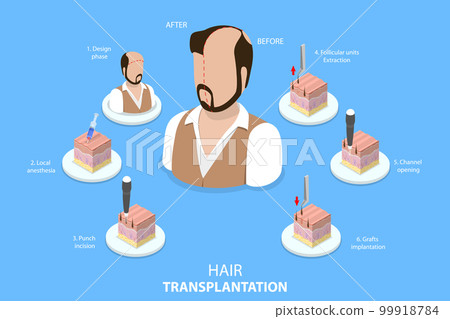 3D Isometric Flat Vector Conceptual Illustration of Hair Transplantation 99918784