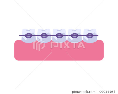 Row of teeth with metal braces flat style, vector illustration Row of teeth with metal braces flat style, vector illustration 99934561