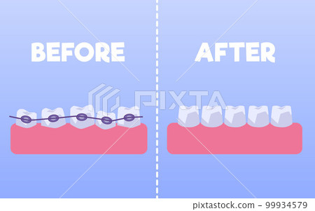 Teeth before and after braces flat style, vector illustration 99934579