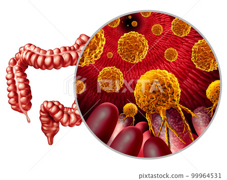 Colon Cancer Growth 99964531