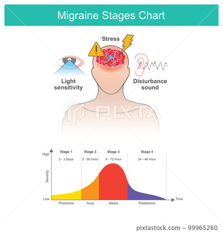 Migraines stages chart, Migraines stages chart and a factors cause of Migraines symptom. Migraines stages chart, Migraines stages chart and a factors cause of Migraines symptom. 99965260
