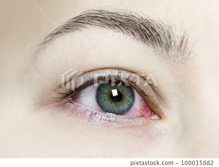 Close up of a severe bloodshot red eye. Viral Blepharitis, Conjunctivitis, Adenoviruses. Irritated or infected eye. Close up of a severe bloodshot red eye. Viral Blepharitis, Conjunctivitis, Adenoviruses. Irritated or infected eye. 100015882