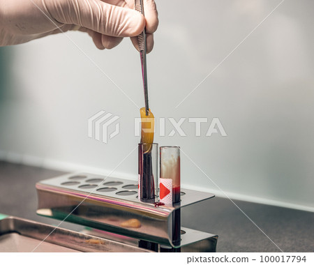 Plateletr rich fibrin Plateletr rich fibrin 100017794