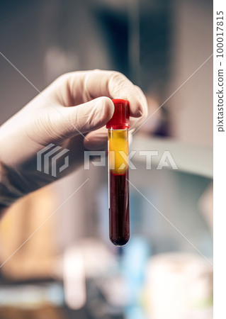Extraction of plasma from blood Extraction of plasma from blood 100017815