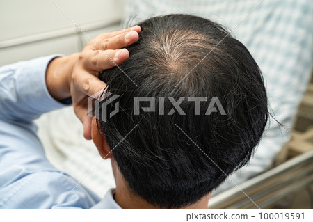Bald in the middle head and begin no loss hair glabrous of mature Asian business smart active office man. Bald in the middle head and begin no loss hair glabrous of mature Asian business smart active office man. 100019591