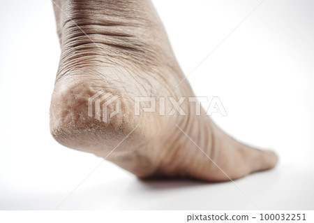 close up of young men dry feet isolated on white close up of young men dry feet isolated on white 100032251