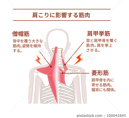 導致肩膀僵硬的背部肌肉 導致肩膀僵硬的背部肌肉 100043845
