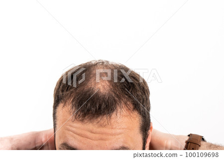 Close-up balding head of a young man on a white isolated background. Close-up balding head of a young man on a white isolated background. 100109698