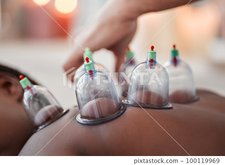 Hands, cupping therapy and spa for healthcare, blood flow or skincare healing to relief back pain or relaxation at resort. Hand of therapist with glass vacuum cups on patient in deep tissue massage 100119969