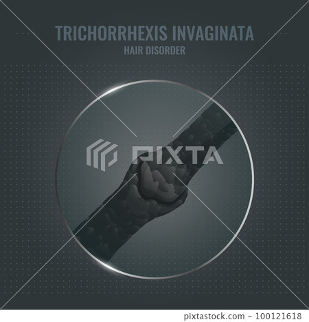 Trichorrhexis invaginata hair brittle disorder in close up Trichorrhexis invaginata hair brittle disorder in close up 100121618