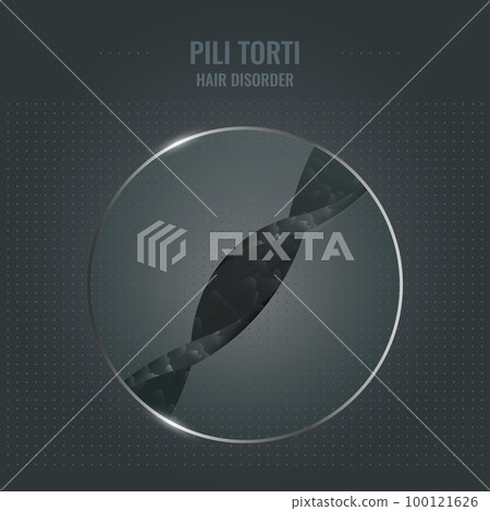 Pili torti hair disorder in close up Pili torti hair disorder in close up 100121626