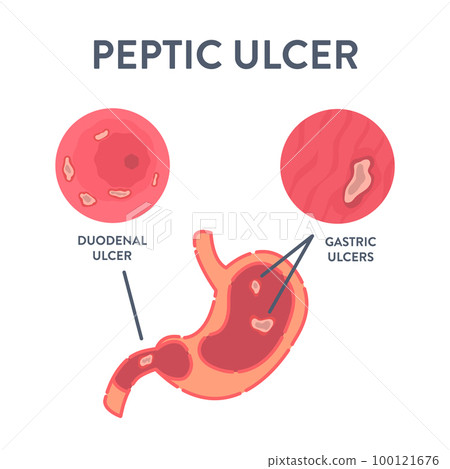 Stomach peptic ulcer detected by endoscopy procedure 100121676