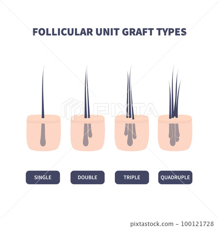 Hair graft types set for hair transplantation 100121728