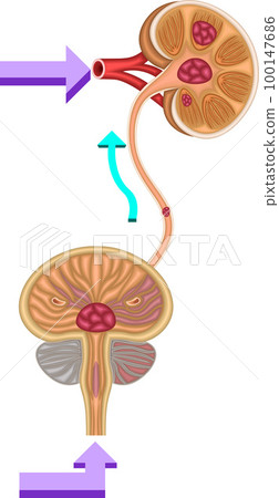 Bladder urinary stone illustration Bladder urinary stone illustration 100147686