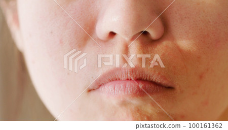 woman acne problem on face 100161362