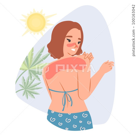 Sunburn vector young woman caring redness shoulder 100163042