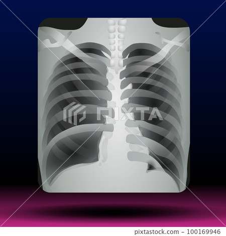 Chest X-ray Scan  100169946