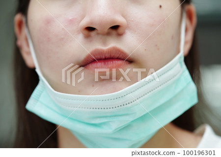 Acne pimple and scar on skin face, disorders of sebaceous glands, teenage girl skincare beauty problem. Acne pimple and scar on skin face, disorders of sebaceous glands, teenage girl skincare beauty problem. 100196301