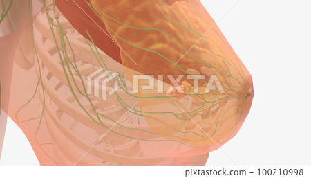 Stage III breast tumors are invasive and have spread to the lymph nodes around the collar bone or those deep within the breast. Stage III breast tumors are invasive and have spread to the lymph nodes around the collar bone or those deep within the breast. 100210998