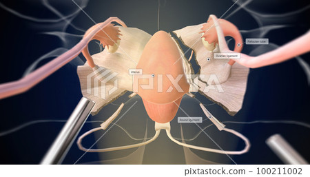 Clipping and Ligating of Fallopian Tubes and Ovarian Ligaments 100211002