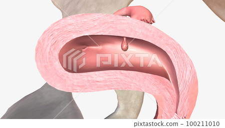 Endometrial polyps are abnormal growths of the inner lining of the uterus, known as the endometrium. 100211010