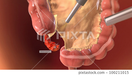 Locating and Grasping the Appendix Locating and Grasping the Appendix 100211015
