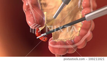 Locating and Grasping the Appendix 100211021