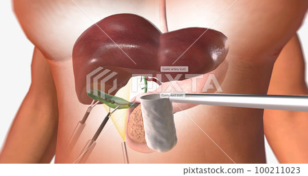 The Removal of the Gallbladder 100211023