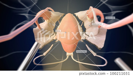 Clipping and Ligating of Fallopian Tubes and Ovarian Ligaments Clipping and Ligating of Fallopian Tubes and Ovarian Ligaments 100211031