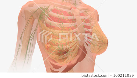 Stage IV breast tumors are invasive and have spread beyond the localized area to the lungs, bones, liver, brain, or to distant lymph nodes. 100211059