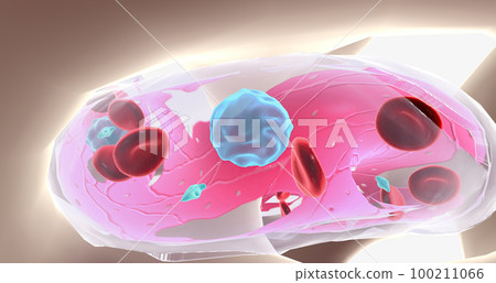 Aplastic anemia is a blood disease characterized by the reduced production of blood cells. 100211066