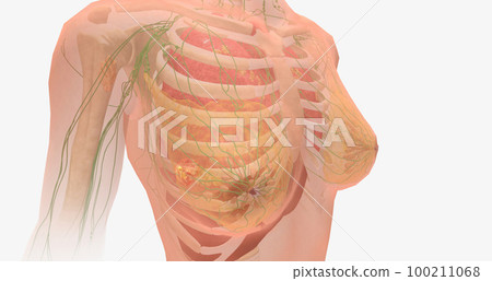 Stage IV breast tumors are invasive and have spread beyond the localized area to the lungs, bones, liver, brain, or to distant lymph nodes. Stage IV breast tumors are invasive and have spread beyond the localized area to the lungs, bones, liver, brain, or to distant lymph nodes. 100211068