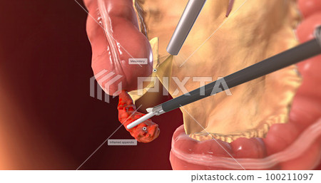 Detaching the Mesentery 3D rendering Detaching the Mesentery 3D rendering 100211097