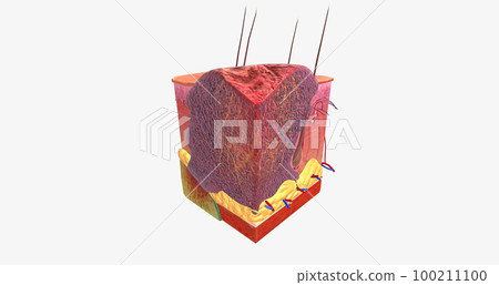 Basal Cell Carcinoma in Tissue, Stage III 100211100