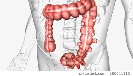 Diverticulosis is a condition characterized by the formation of diverticula in the walls of the intestines. 100211110