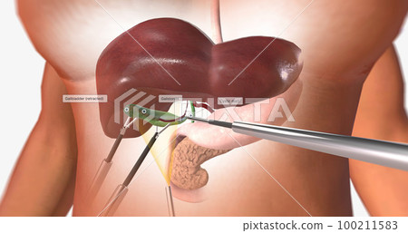 Clipping and Ligating the Cystic Artery and Duct Clipping and Ligating the Cystic Artery and Duct 100211583