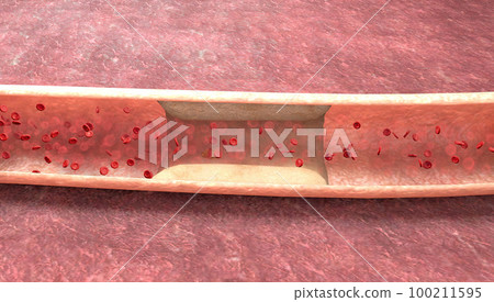 The blockage in the veins is called chronic venous obstruction. The blockage in the veins is called chronic venous obstruction. 100211595