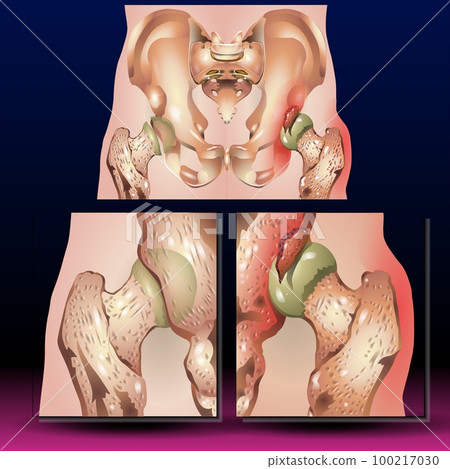 Pelvis Hip Fracture  100217030
