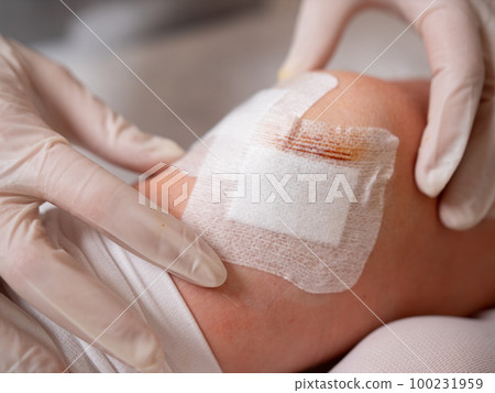 Close-up of female hands of a nurse in sterile gloves at the knee of a patient after arthroscopy surgery. Close-up of female hands of a nurse in sterile gloves at the knee of a patient after arthroscopy surgery. 100231959