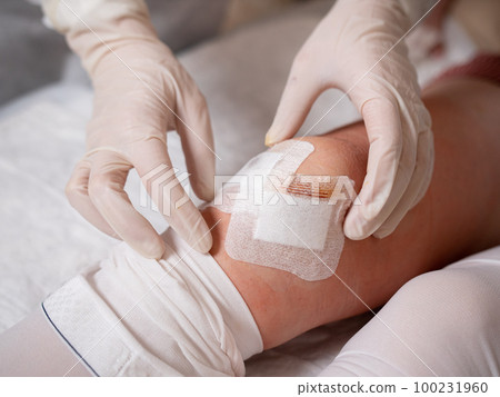 The nurse's hands in medical gloves stick a sterile patch on the incision in the patient's knee after arthroscopy surgery. The nurse's hands in medical gloves stick a sterile patch on the incision in the patient's knee after arthroscopy surgery. 100231960