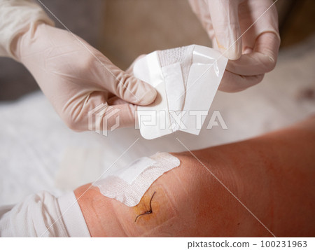 Close-up of the replacement of a sterile patch by a nurse with a glove on a patient's knee after surgery Close-up of the replacement of a sterile patch by a nurse with a glove on a patient's knee after surgery 100231963