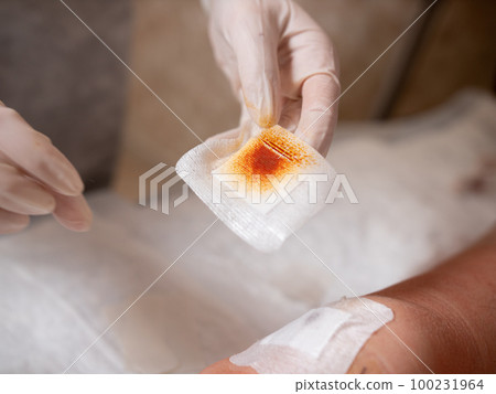 Close-up of a sterile patch with iodine solution. 100231964