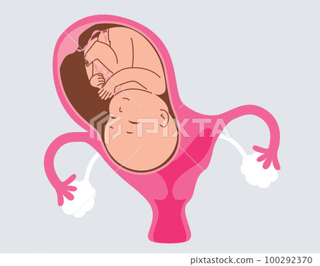 Bicornuate Uterus During Pregnancy With Baby 100292370