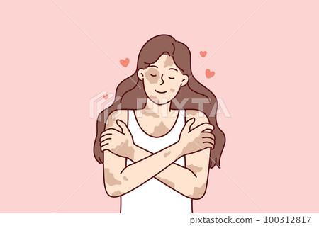 Positive girl with vitiligo disease hugging herself taking skin diseases as personal feature 100312817